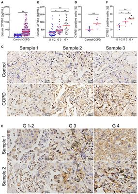 Serum CYR61 Is Associated With Airway Inflammation and Is a Potential Biomarker for Severity in Chronic Obstructive Pulmonary Disease